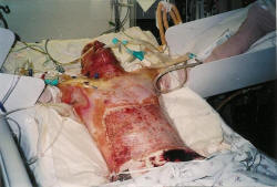 Burned sewer service contractor employee.